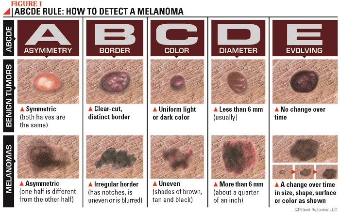 melanoma-follow-up